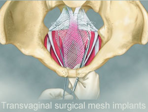 Transvaginalsurgicalmesh
